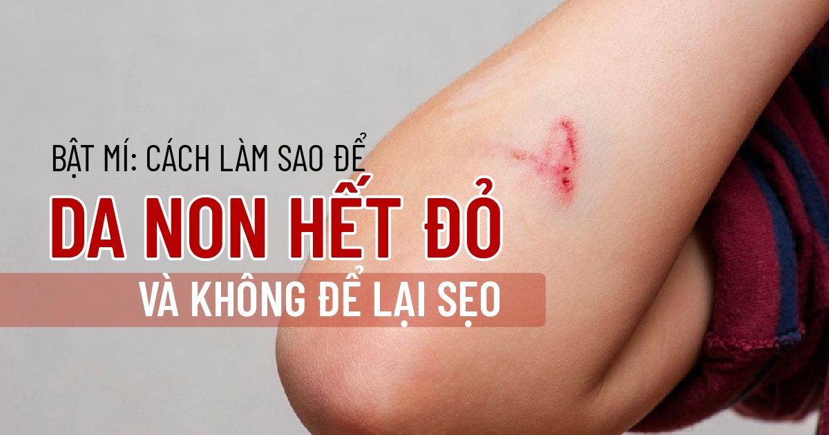 Bật mí: Cách làm sao để da non hết đỏ và không để lại sẹo