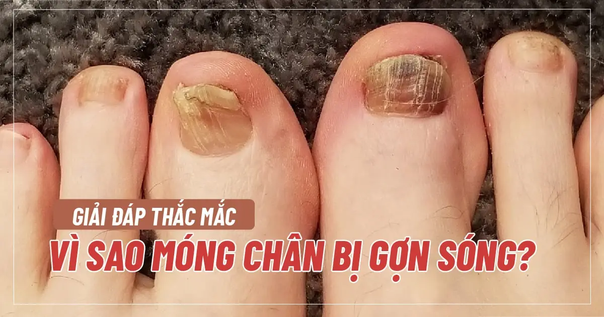 Giải đáp thắc mắc: Vì sao móng chân bị gợn sóng?