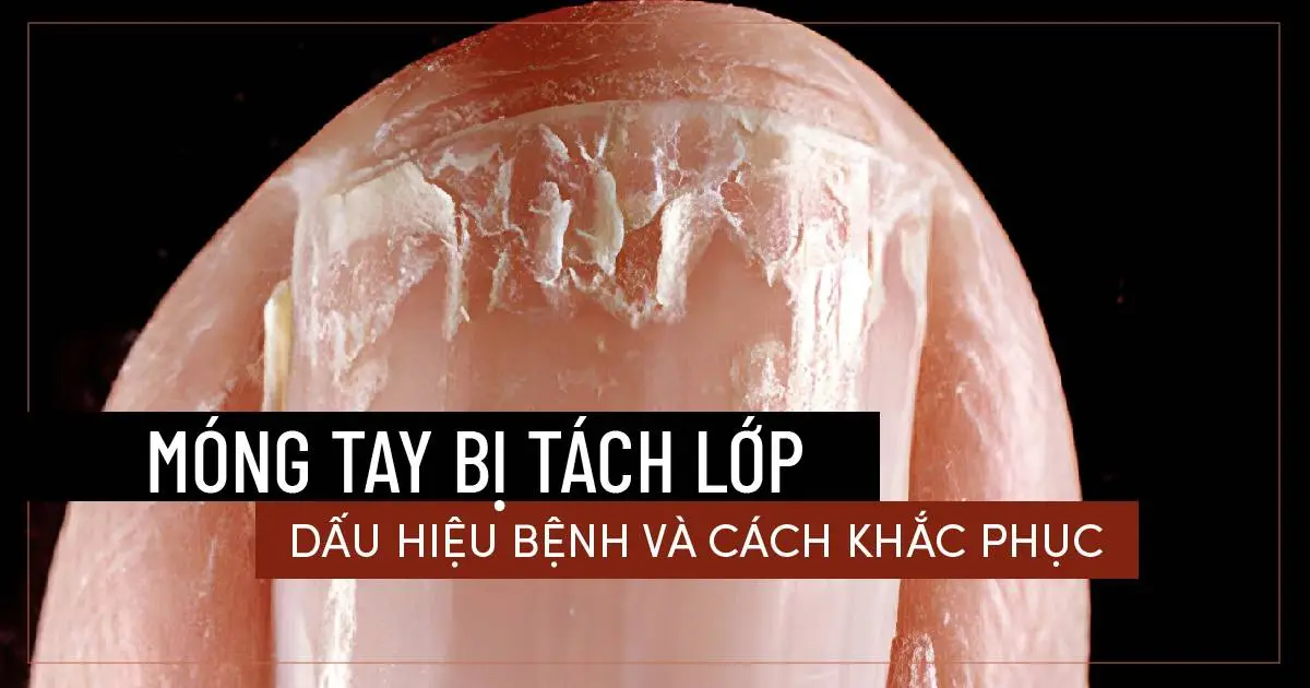 Móng tay bị tách lớp: Dấu hiệu bệnh và cách khắc phục