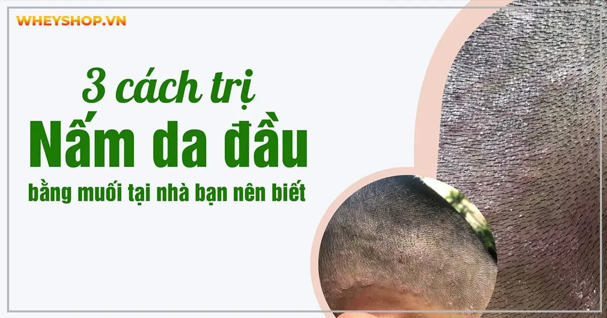 [Bật Mí] 3 cách trị nấm da đầu bằng muối tại nhà bạn nên biết