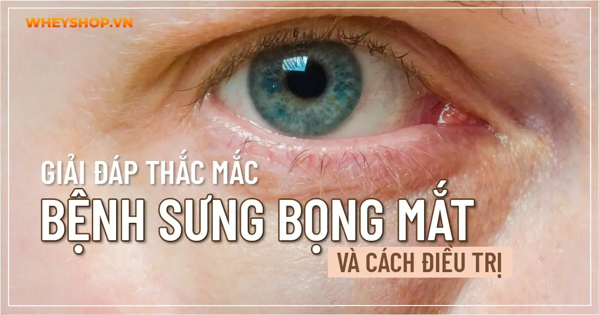 Giải đáp thắc mắc: Bệnh sưng bọng mắt và cách điều trị