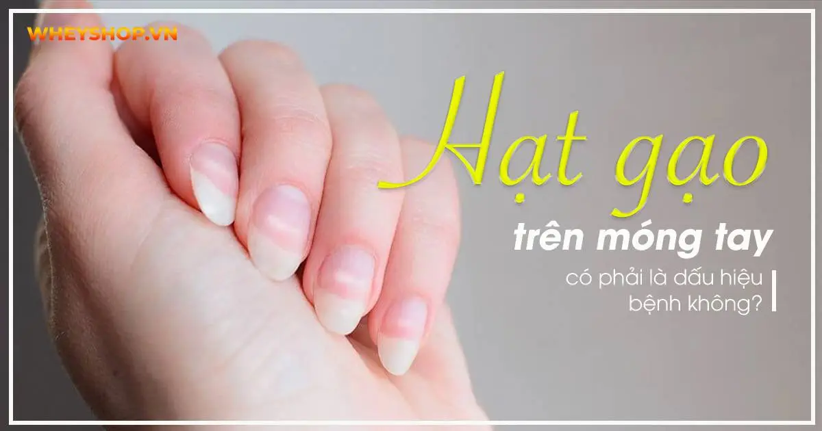 Hạt gạo trên móng tay có phải là dấu hiệu bệnh không?