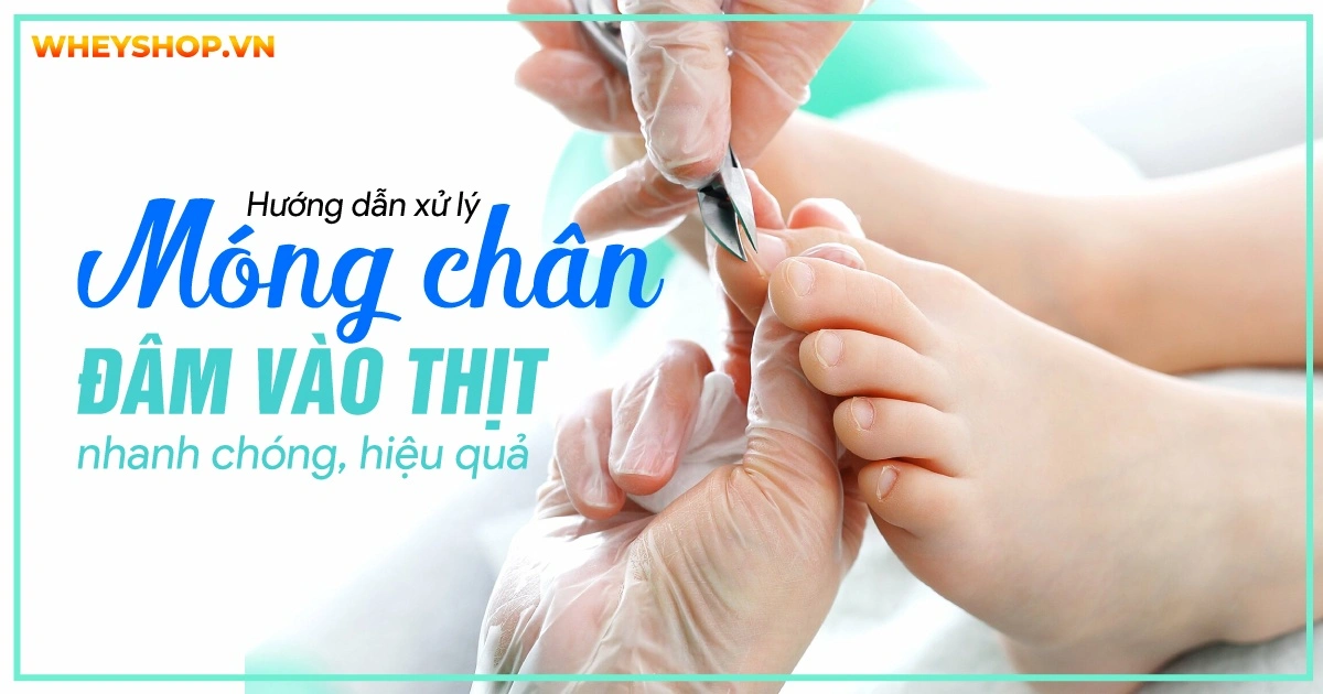 Hướng dẫn xử lý móng chân đâm vào thịt nhanh chóng, hiệu quả