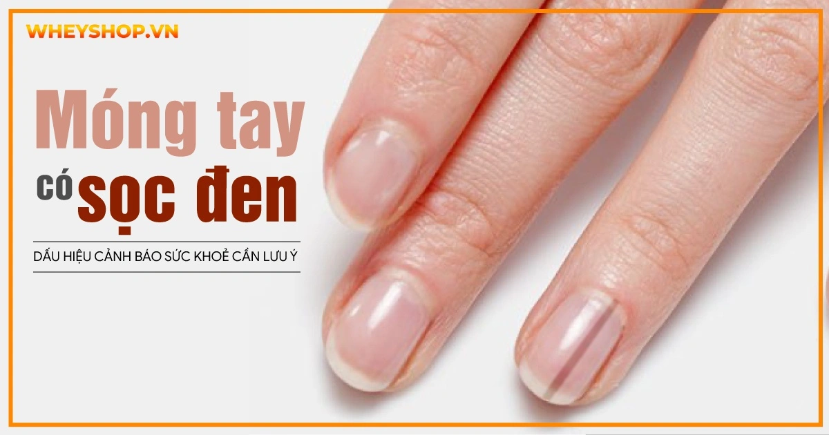 Móng tay có sọc đen: Dấu hiệu cảnh báo sức khoẻ cần lưu ý