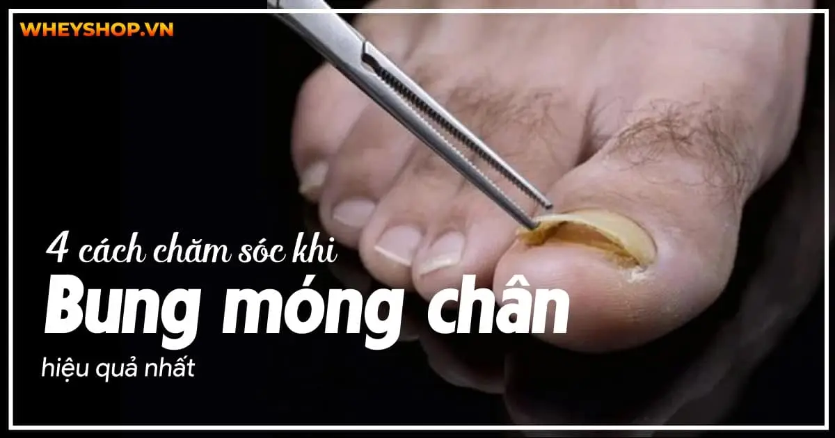 Top 4+ cách chăm sóc khi bị bung móng chân hiệu quả