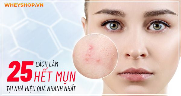 Gợi ý 25 cách làm hết mụn tại nhà hiệu quả nhanh nhất