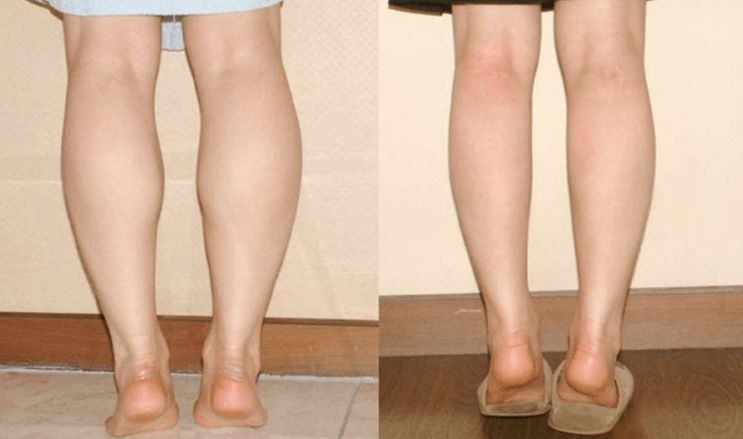 Cùng Dinh Dưỡng Thể Hình tìm hiểu về nguyên nhân bắp chân to và cách giải quyết vấn đề bắp chân to vô cùng đơn giản mà bạn chưa biết tới....