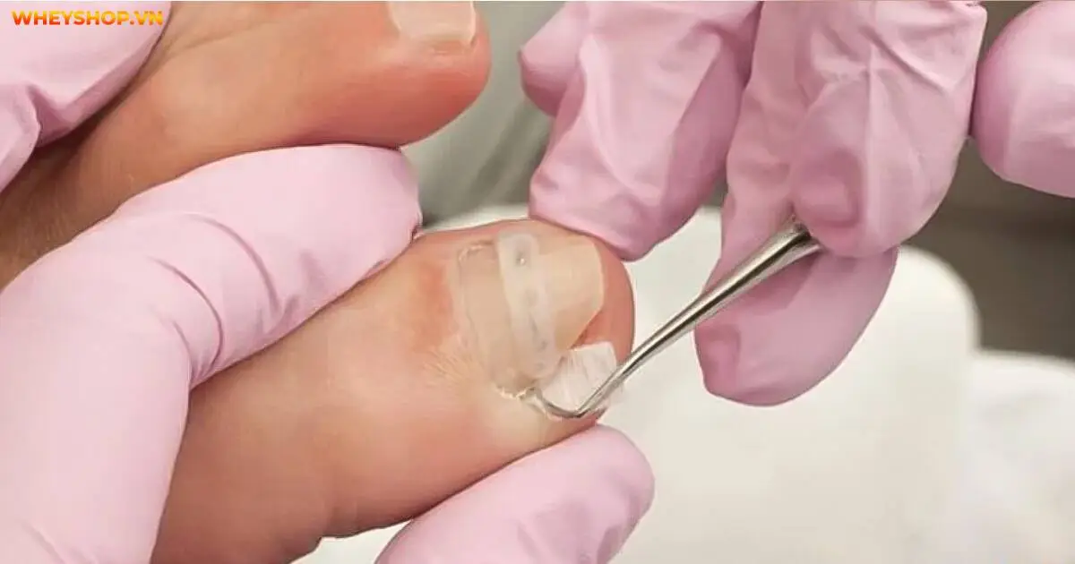 4-cach-cham-soc-khi-bi-bung-mong-chan-hieu-qua(1)