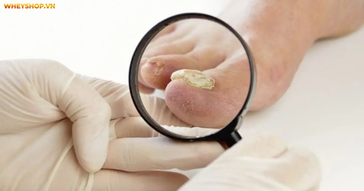 4-cach-cham-soc-khi-bi-bung-mong-chan-hieu-qua(1)