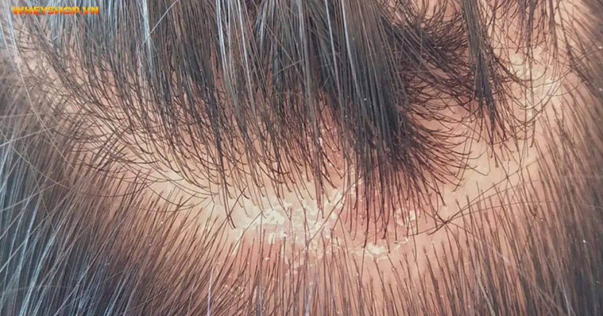 bat-mi-3-cach-tri-nam-da-dau-bang-muoi-tai-nha-2