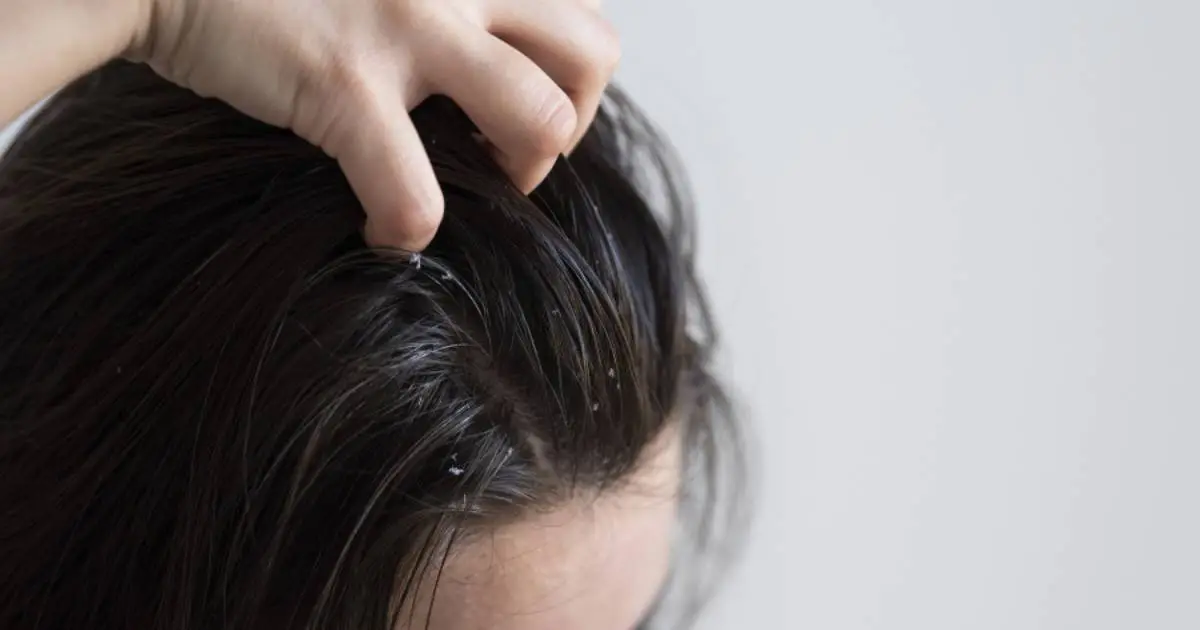 bat-mi-3-cach-tri-nam-da-dau-bang-muoi-tai-nha-3