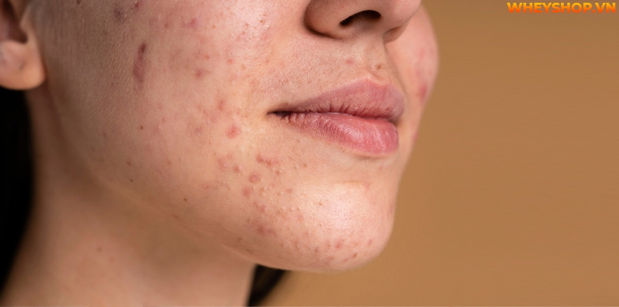 Chúng ta cần một cách chăm sóc da dầu mụn đặc biệt hơn các loại da khác, vì da dầu thường rất dễ bị mụn ẩn. Mụn ẩn được biết đến là một trong những loại mụn...