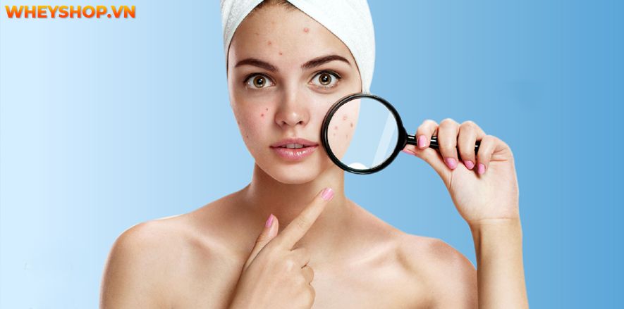 Nếu bạn đang băn khoăn tìm cách trị mụn đơn giản tại nhà hiệu quả thì hãy cùng WheyShop tham khảo 12 cách trị mụn tự nhiên, hiệu quả...