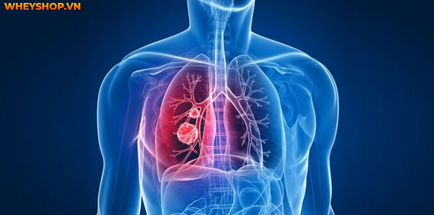 Nếu bạn đang băn khoăn khi bị lao phổi nhưng không ho thì hãy cùng WheyShop tìm hiểu nguyên nhân và giải đáp qua bài viết...