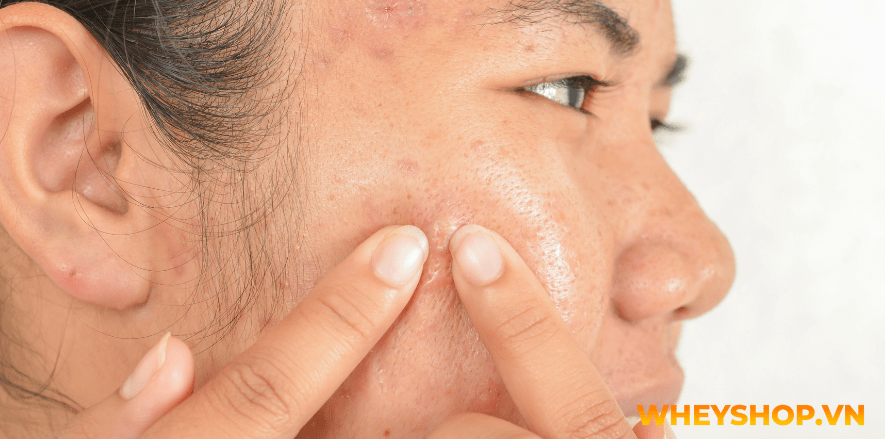 Các bước dưỡng da ban đêm vô cùng quan trọng bởi nếu không dầu thừa trên da là một trong những nguyên nhân phổ biến nhất gây ra mụn, gây bít lỗ chân lông và...