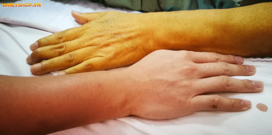 Bạn thường xuyên chạy bộ tuy nhiên sự thật chạy bộ có tốt cho gan không? WheyShop sẽ giúp bạn giải đáp thắc mắc này nhé!