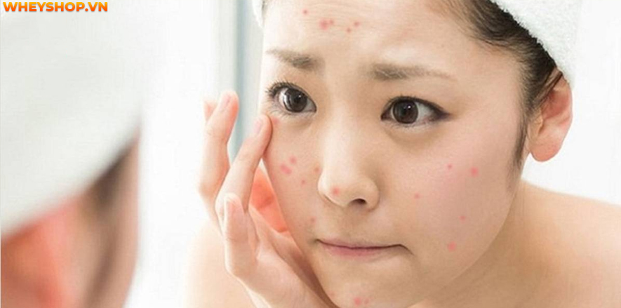 Mụn luôn là "kẻ thù" của nhiều chị em phụ nữ. Vậy làm cách nào để hết mụn? Bài viết dưới đây sẽ bật mí 25 cách làm hết mụn tại nhà hiệu quả, đơn giản, dễ...