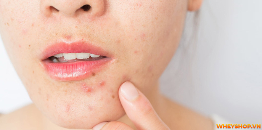 Mụn luôn là "kẻ thù" của nhiều chị em phụ nữ. Vậy làm cách nào để hết mụn? Bài viết dưới đây sẽ bật mí 25 cách làm hết mụn tại nhà hiệu quả, đơn giản, dễ...