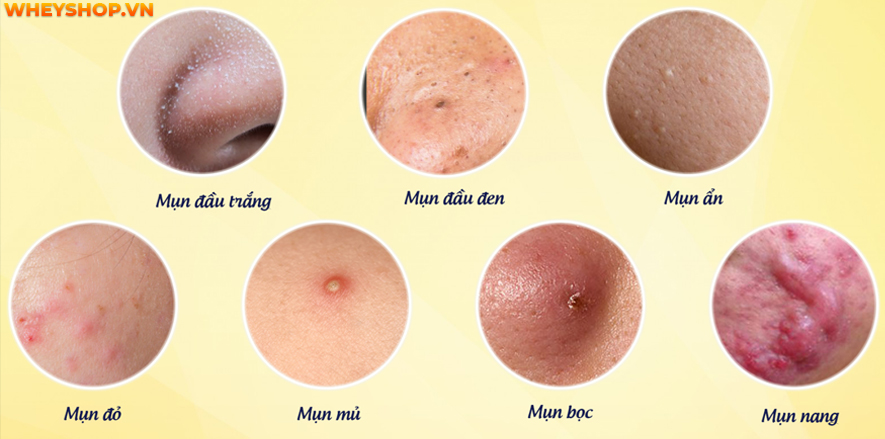 Mụn luôn là "kẻ thù" của nhiều chị em phụ nữ. Vậy làm cách nào để hết mụn? Bài viết dưới đây sẽ bật mí 25 cách làm hết mụn tại nhà hiệu quả, đơn giản, dễ...