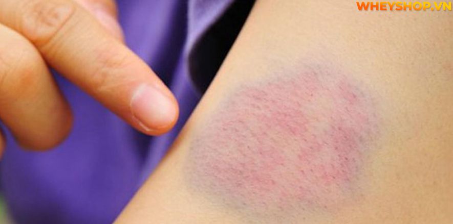 Hiện tượng đau cơ mông từ nhẹ đến nặng ở mông làm giảm sức mạnh của đôi chân và ảnh hưởng đến chất lượng cuộc sống của người bệnh. Nguyên nhân của cơn đau...