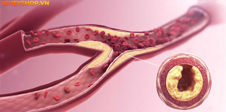 Hiện tượng đau cơ mông từ nhẹ đến nặng ở mông làm giảm sức mạnh của đôi chân và ảnh hưởng đến chất lượng cuộc sống của người bệnh. Nguyên nhân của cơn đau...