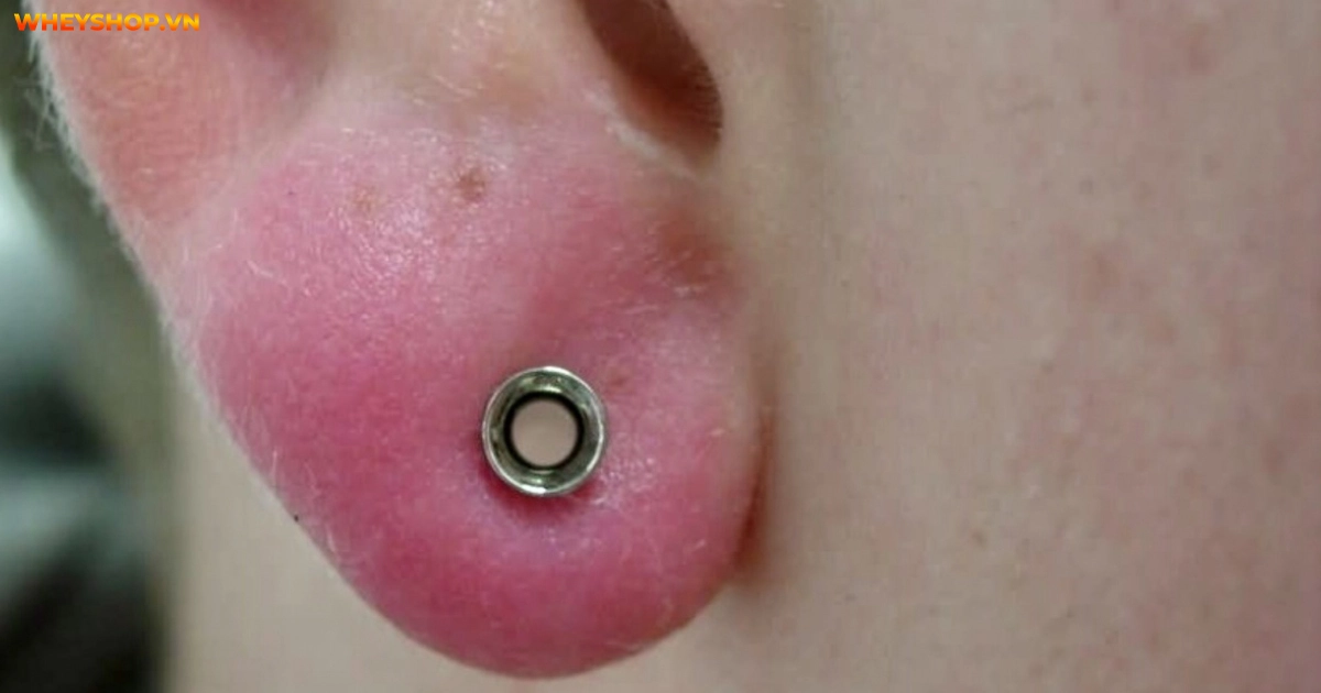 huong-dan-cach-chua-bam-lo-tai-bi-mung-mu-don-gian-hieu-qua(1)