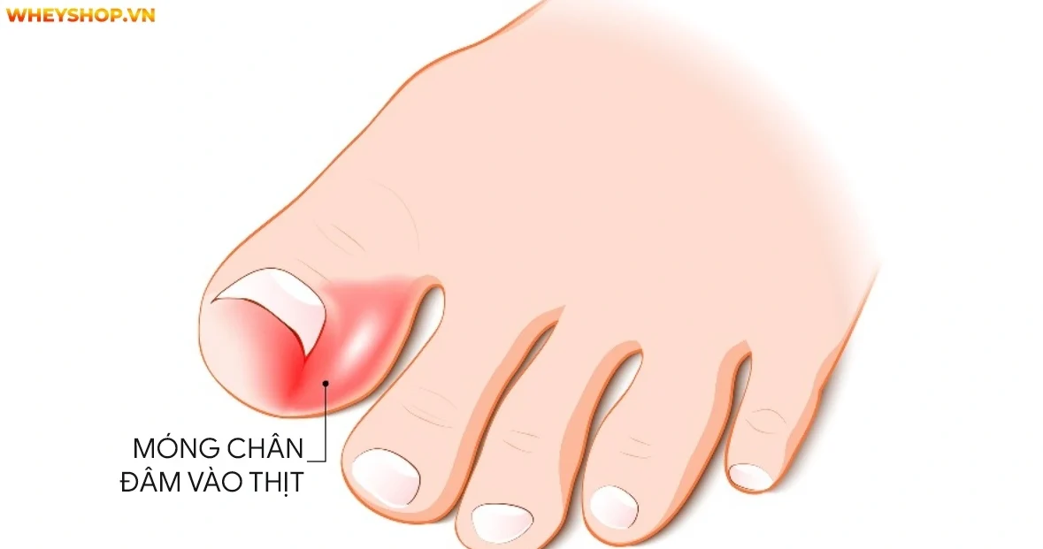 huong-dan-xu-ly-mong-chan-dam-vao-thit-nhanh-chong