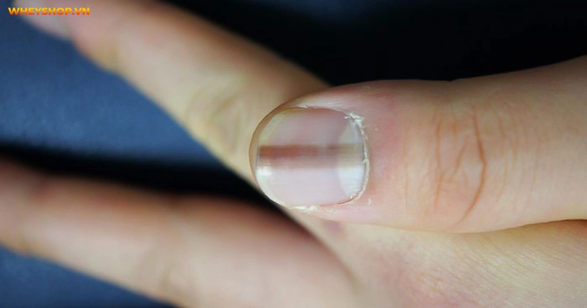 mong-tay-co-soc-den-dau-hieu-canh-bao-suc-khoe