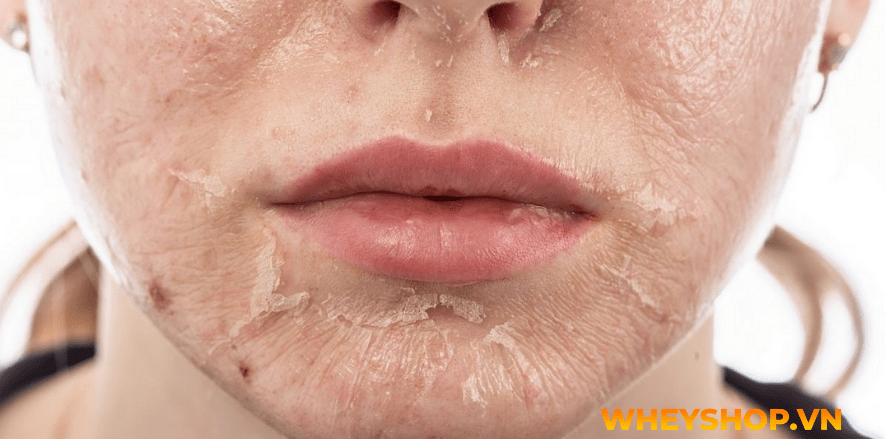 Nếu bạn đang băn khoăn việc peel da tại nhà và những lưu ý khi peel da thì hãy cùng WheyShop tham khảo chi tiết bài viết ngay sau đây nhé...