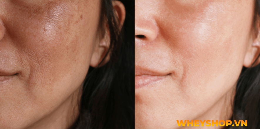 Nếu bạn đang băn khoăn việc peel da tại nhà và những lưu ý khi peel da thì hãy cùng WheyShop tham khảo chi tiết bài viết ngay sau đây nhé...