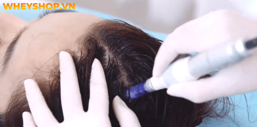 Nếu bạn quan tâm đến việc làm đẹp và các vấn đề về da thì chắc hẳn bạn đã từng nghe hoặc đọc về phương pháp cấy máu tự thân PRP. Vậy thực chất PRP là gì mà...