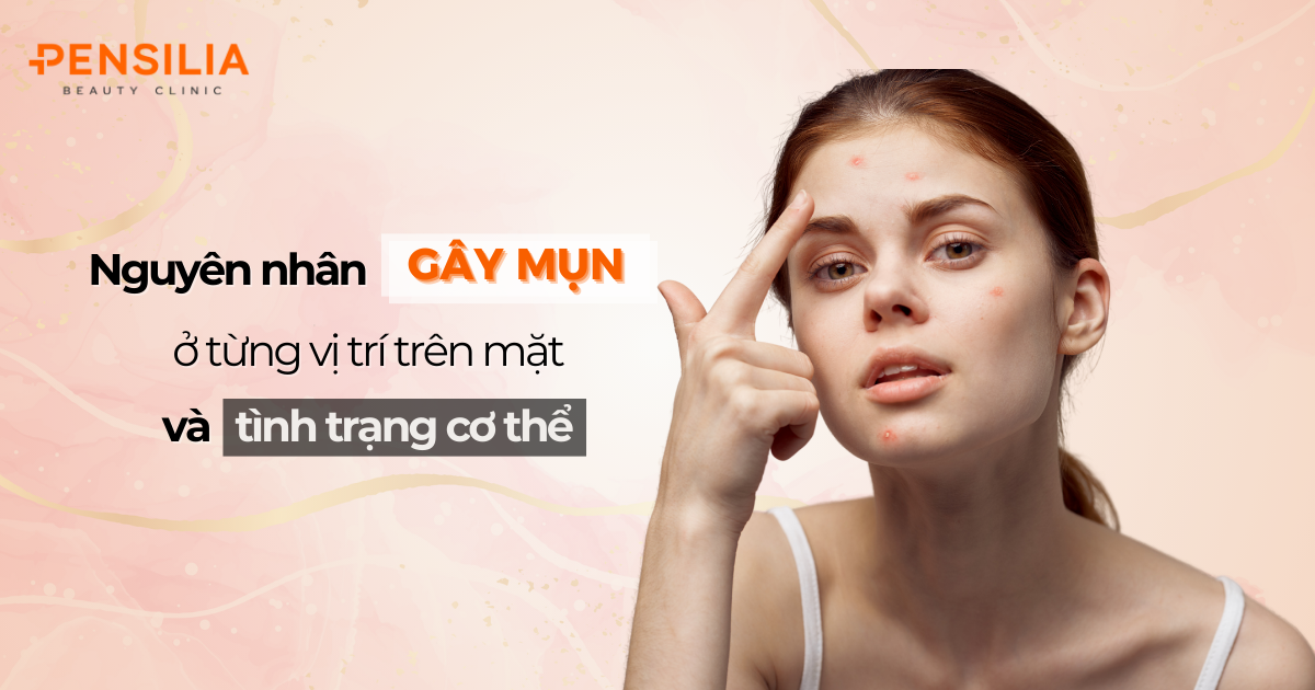 Nguyên nhân gây mụn ở từng vị trí trên mặt và tình trạng sức khỏe