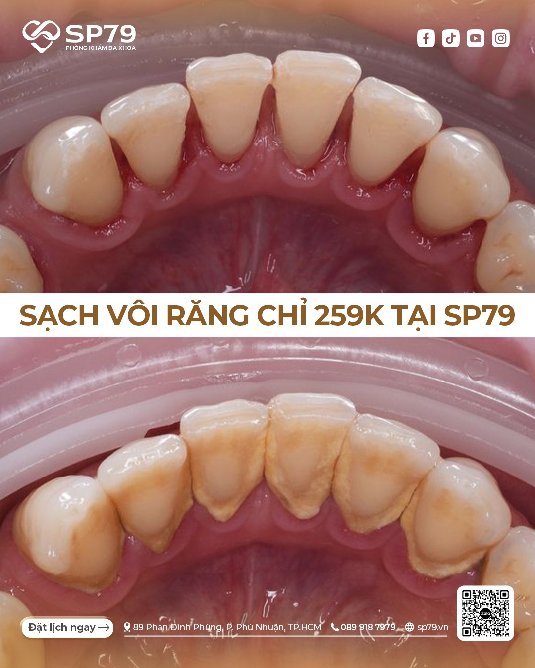 CẠO VÔI RĂNG CHỈ 259K: COMBO 