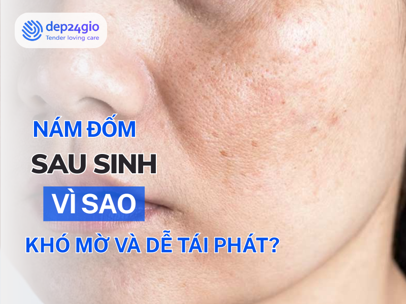 Nám đốm sau sinh: Vì sao khó mờ và dễ tái phát?