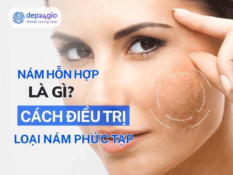 Nám hỗn hợp là gì? Cách điều trị loại nám phức tạp nhất
