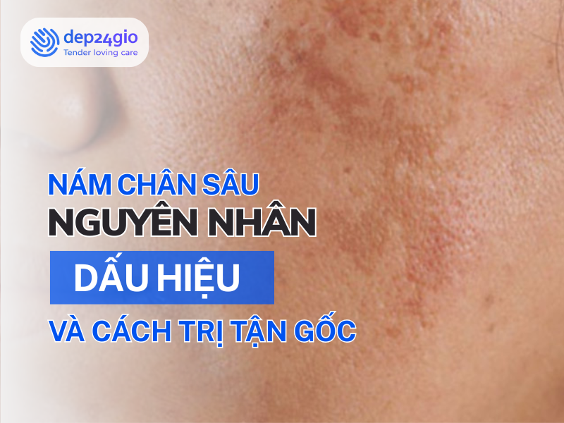 Nám chân sâu: Nguyên nhân, dấu hiệu và cách trị tận gốc