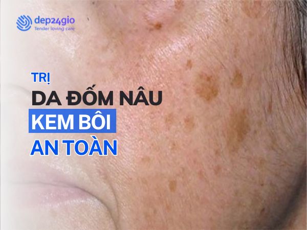 Trị Da Nổi Đốm Nâu Với Kem Bôi Thoa An Toàn