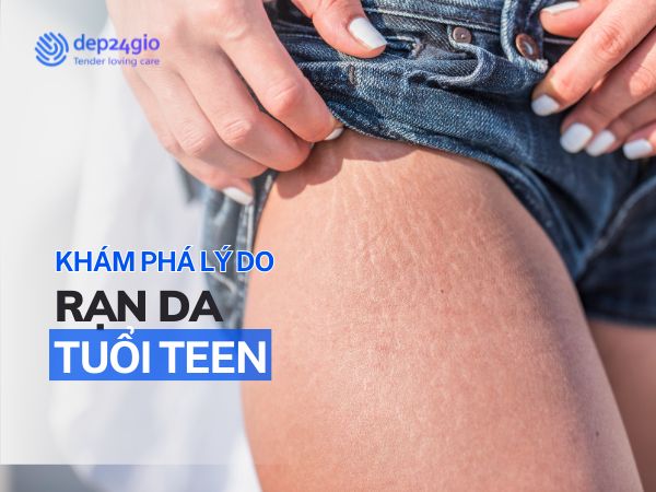 Chuyên gia giải thích tại sao bị rạn da ở tuổi dậy thì