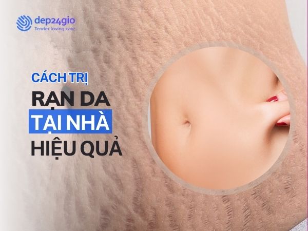 Cách trị rạn da hiệu quả và an toàn tại nhà