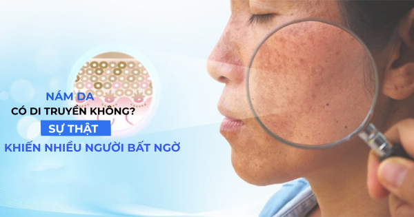 Nám Da Có Di Truyền Không? Sự Thật Bất Ngờ