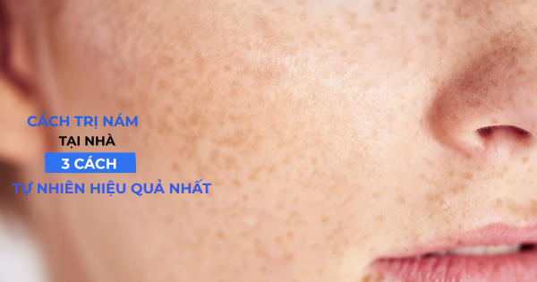 Cách Trị Nám Tại Nhà: 3 Cách Tự Nhiên Hiệu Quả Nhất