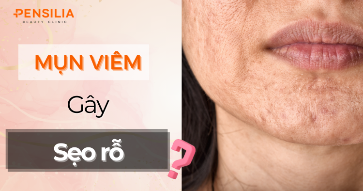 Tại Sao Mụn Viêm Gây Sẹo Rỗ? Cách Phòng Ngừa An Toàn