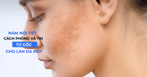 Nám nội tiết: Cách phòng và trị từ gốc cho làn da đẹp