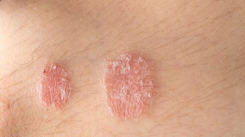 Mẹo Hay Về Lá Chè Giúp Giảm Ngứa , Chữa Tri Các Bệnh Về Da Mẹo Hay Về Lá Chè Giúp Giảm Ngứa , Chữa Tri Các Bệnh Về Da