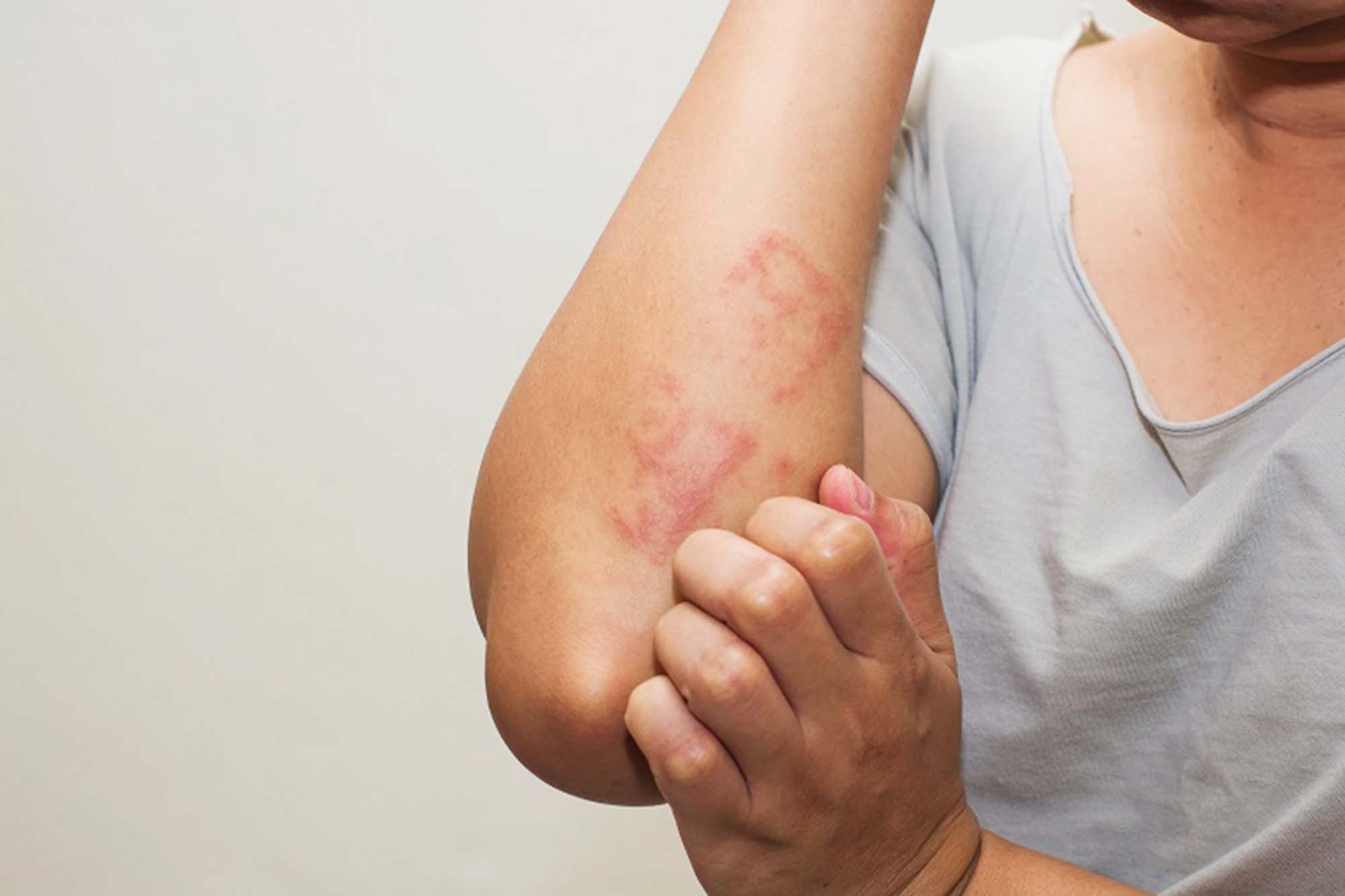 Cây Bọ Mẩy và Lợi Ích Chăm Sóc Da Tự Nhiên Cây Bọ Mẩy và Lợi Ích Chăm Sóc Da Tự Nhiên