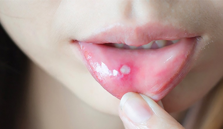 Phương Pháp Chữa Trị Nhiệt Miệng Tại Nhà Nhờ Cây Hoàng Liên Phương Pháp Chữa Trị Nhiệt Miệng Tại Nhà Nhờ Cây Hoàng Liên
