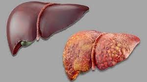 Giải Độc Gan Hiệu Quả Nhờ Cây Bèo Cái Giải Độc Gan Hiệu Quả Nhờ Cây Bèo Cái