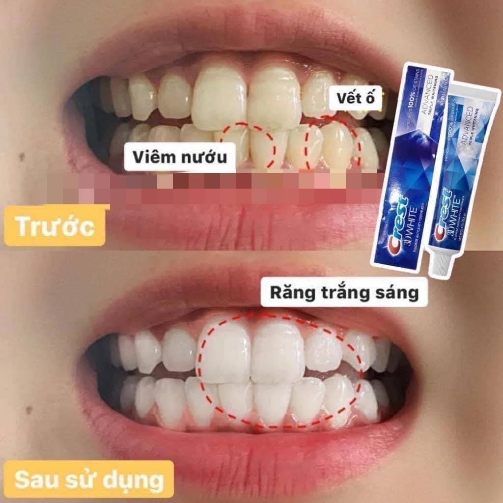 1 tuýp kem đánh răng crest 3d white advanced whitening tuýp 147g crest Mỹ