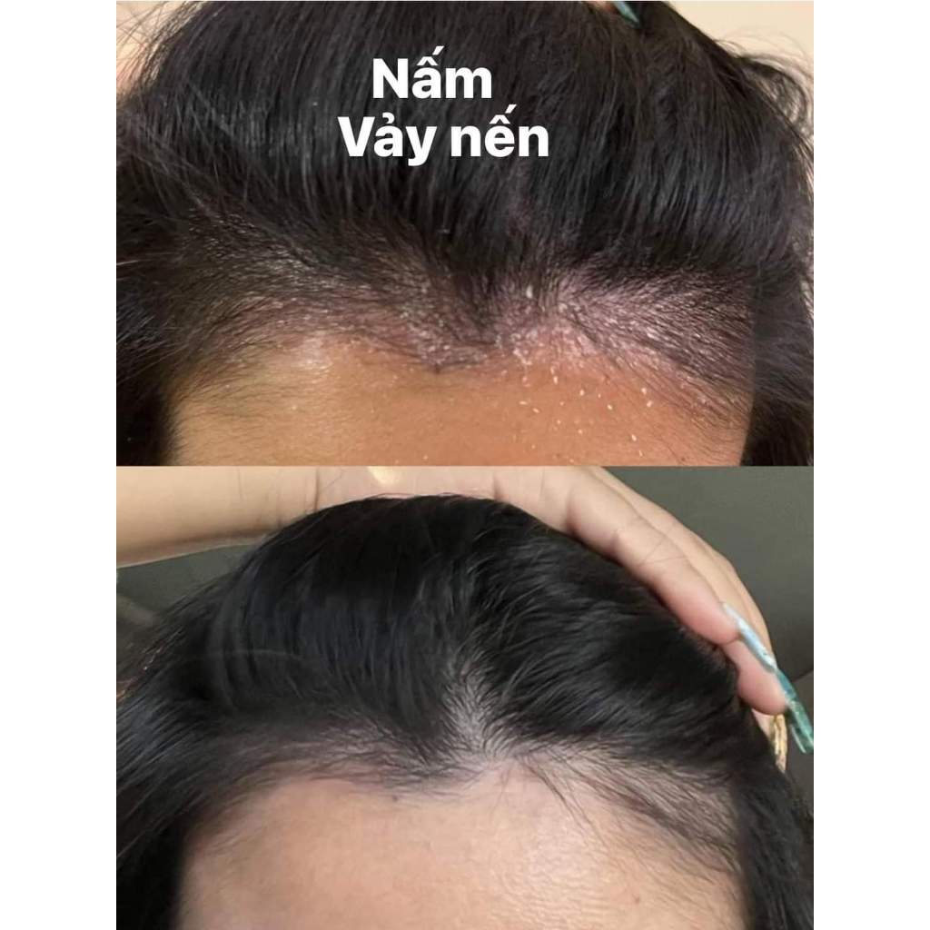 [CHÍNH HÃNG MỸ] Bộ Sưu Tập Dầu Gội Trị Gàu Selsun Blue – Giải Pháp Chuyên Biệt Cho Mọi Loại Da Đầu