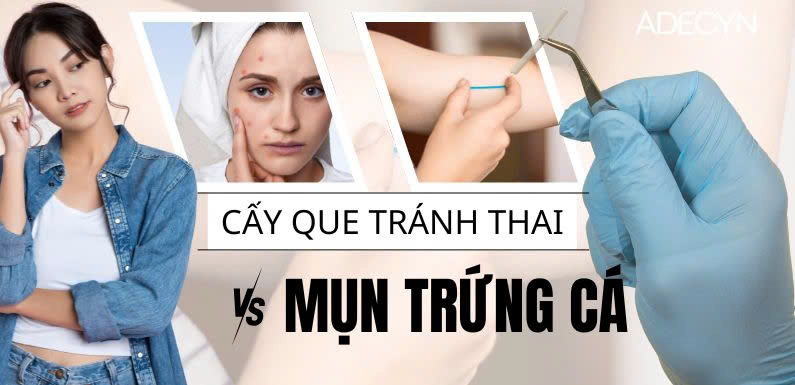 Cấy que tránh thai và Mụn trứng cá